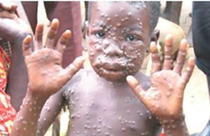 MonkeyPox: Osun Places Health Officials On Red Alert Monkey Pox patient