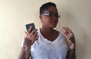 Read The Pathetic Story Of This Young Lady Suffering From Vitiligo, She Speaks About Rejection, Stigmatization and Tradition Kehinde Mosunmola Taiwo...the vitiligo lady...tells her story...