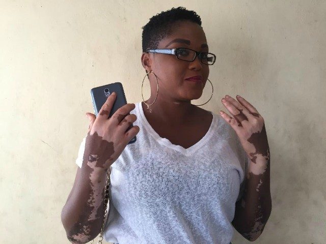Kehinde Mosunmola Taiwo...the vitiligo lady...tells her story...