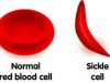 NGO To FG: It’s Time To Categorise Sickle Cell Patients As PLWDs