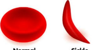 NGO To FG: It’s Time To Categorise Sickle Cell Patients As PLWDs