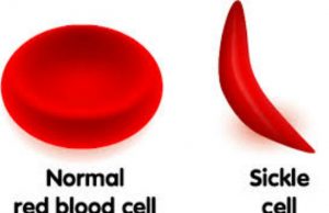 NGO To FG: It’s Time To Categorise Sickle Cell Patients As PLWDs