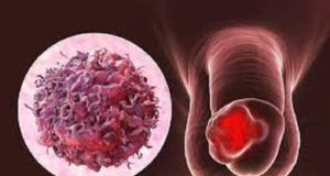 Battle Against Penile Cancer: 6,500 Penises Amputated So Far In Brazil