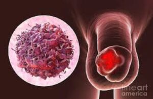 Battle Against Penile Cancer: 6,500 Penises Amputated So Far In Brazil