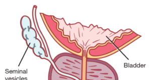 Embrace Early Screening For Prostate Cancer, Experts Urge Nigerian Men