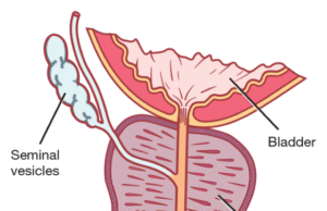 Embrace Early Screening For Prostate Cancer, Experts Urge Nigerian Men
