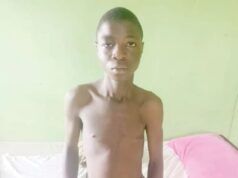 Hernia Surgery: Family Seeks ₦300,000 For 16-Year-Old ...the inguinal hernia patient...
